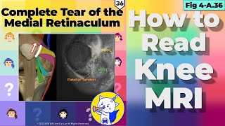 Fig 4A36 Complete Tear of the Medial Retinaculum [upl. by Kallick]