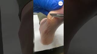 Callus formation on bunionette removed by podiatrist [upl. by Sherborne]