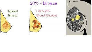 Fibrocystic breast Causes Symptoms and Treatment Fibrocystic Breast Disease [upl. by Sirtemed624]