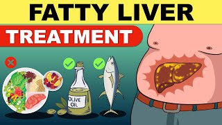 Fatty Liver Treatment  Fatty Liver Diet  Liver Detox  Fatty Liver  Fatty Liver Symptoms [upl. by Aikenat]