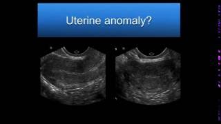 AIUM Webinar Problem Solving with 3D Sonography of the Uterus and Adnexa [upl. by Nonek445]