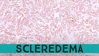 Scleredema NOT pretibial myxedema or scleromyxedema pathology dermpath dermatology [upl. by Ace423]