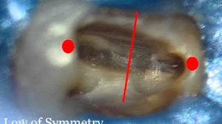 Finding canals with Endosuccess Satelec Ultrasonic Tips [upl. by Fein606]