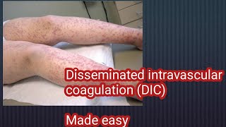 Disseminated intravascular coagulation DIC made easy [upl. by Atteuqihc]