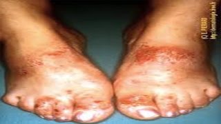 comment traiter  eczema du pied [upl. by Ansilma570]