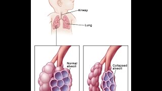 Respiratory Distress Syndrome [upl. by Eiram]