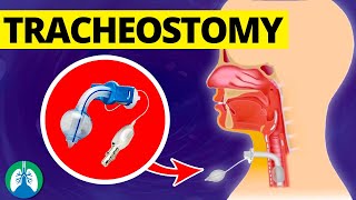 Tracheostomy Medical Definition  Quick Explainer Video [upl. by Enyahc]