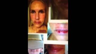 Carac Flourouracil Topical Chemotherapy Treatment on Lips [upl. by Dorkus]