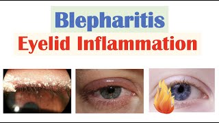 Blepharitis Eyelid Inflammation  Causes Risk Factors Signs amp Symptoms Diagnosis Treatment [upl. by Fawnia816]