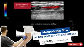 Monophasic flow in the posterior tibial artery  Ultrasound [upl. by Normalie]