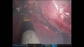 Robotic cholecystectomy for GB empyema [upl. by Ibocaj]