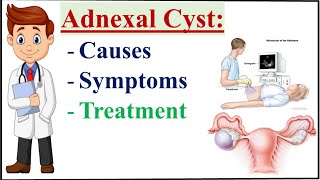 Adnexal cyst Causes Symptoms and Treatment of Adnexal cyst [upl. by Eelsew]