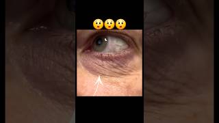 आँख फड़कने का कारण । EYELID TWITCHING । WHAT IS MYOKYMIA [upl. by Bena778]