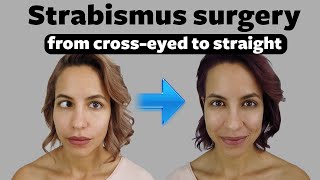 Strabismus surgery Fixing my crossed eyes and vision [upl. by Edasalof]