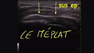 Echo Tuto Epaule 4 le tendon supra épineux normal et pathologique [upl. by Kurland]