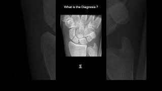 Scaphoid fracture  Ulnar deviation view 89 Trauma Xray Upper limb Wrist radiologychannel007 [upl. by Roice213]