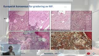 Seminar om MPN Myelofibrose MF ved Hoa Tran 221122 [upl. by Lerrad]