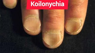 Leukonychia Platynychia and Koilonychia in Chronic iron deficiency anemia [upl. by Demaria128]