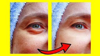 4 Remedios Caseros Para Eliminar Ojeras Y Bolsas Bajo Los Ojos [upl. by Russian]