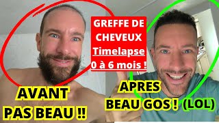 6 MOIS Greffe de cheveux AVANTAPRÈS Mes résultats  évolution avec la Meilleure clinique quotKLINEVAquot [upl. by Marley]