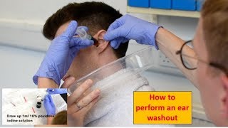 How to Perform an Ear Washout irrigation  ENTOtolaryngology Skills [upl. by Warrenne]