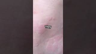 What is Urticaria disease most common nowadays urticaria trending viralvideo viral shorts you [upl. by Mazel]