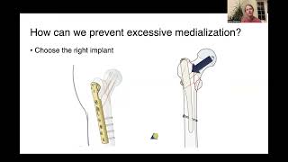 Intertrochanteric and Subtrochanteric Fractures [upl. by Neehsar121]