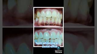 Teeth whitening in the Dental office by Dr Aftab jahan smile designing dentist teeth whitening [upl. by Konikow633]