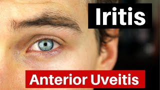 Iritis  What is Anterior Uveitis Doctor Explains [upl. by Nim]