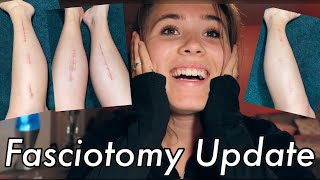 Fasciotomy Recovery  Post Surgery Update from Chronic Exertional Compartment Syndrome [upl. by Yejus]