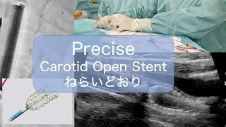 Precise Carotid Open Stent 頚動脈用オープンステントの置き方 [upl. by Cleodel]