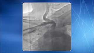 Chapter 14 TRA for addressing Subclavian amp Innominate Artery Lesions [upl. by Uon219]