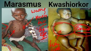 Protein Energy Malnutrition Biochemistry  Marasmus Vs Kwashiorkor  Kwashiorkor  Marasmus [upl. by Marder]