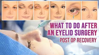 Eyelid Surgery day by day recovery  Eyelid surgery swelling amp scar healing time Dr Shruti Marwah [upl. by Phelan937]