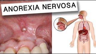 How Does Anorexia Effect Your Oral Health [upl. by Suravart]