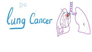 Lung Cancer  Bronchogenic Carcinoma  The most COMPREHENSIVE Explanation [upl. by Anaidirib]