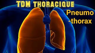 SCANNER THORACIQUE Pneumothorax avec collapsus passif [upl. by Yenots]