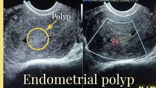 Ultrasound Report of endometrial polyp Sonography of Endometrial masspolyp [upl. by Ahsiakal816]