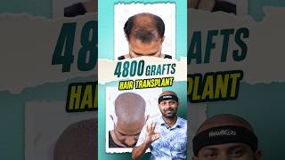 4800 Grafts Hair Transplant in Bangladesh hairtransplant bangladesh shorts ytshorts [upl. by Nisaj]