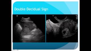 Introduction to 1st Trimester Pregnancy Ultrasound [upl. by Cord]