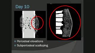 Lecture 3 MSK Osteomyelitis [upl. by Ilanos938]