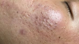 ACNE TREATMENT VU QUYNH MI  Blackheads On Boy Chin 2024FULL [upl. by Lled15]