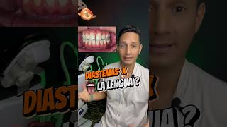 Diastemas por culpa de la LEMGUA 😛 brackets ortodoncia diastema [upl. by Schrader]