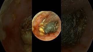 COMPLETE Package Of Earwax With Fungi [upl. by Vasily]