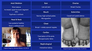 Turner Syndrome Dysmorphic Features [upl. by Savadove585]