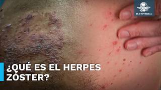 Al menos 30 de las personas que padecieron varicela tendrán herpes zoster en algún momento [upl. by Araek]