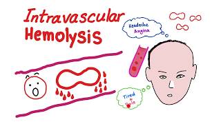 Intravascular Hemolysis [upl. by Tega595]