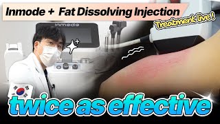 InMode  Fat dissolving Injection popular in Korea  procedure LIVE [upl. by Yesllek722]