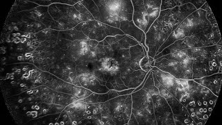 Fundus Fluorescein Angiography FFA Detail explanation [upl. by Jasper]