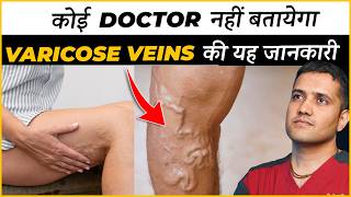 Real Information About Varicose Veins Treatment That No Doctor Will Tell You  Dr Gaurav IR [upl. by Anne]